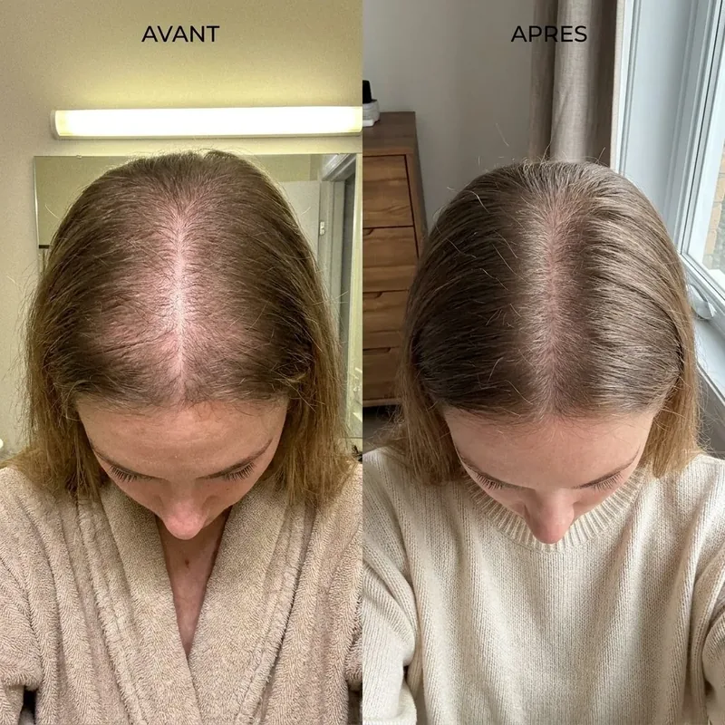 Avant/Après — Raie après 8 semaines
